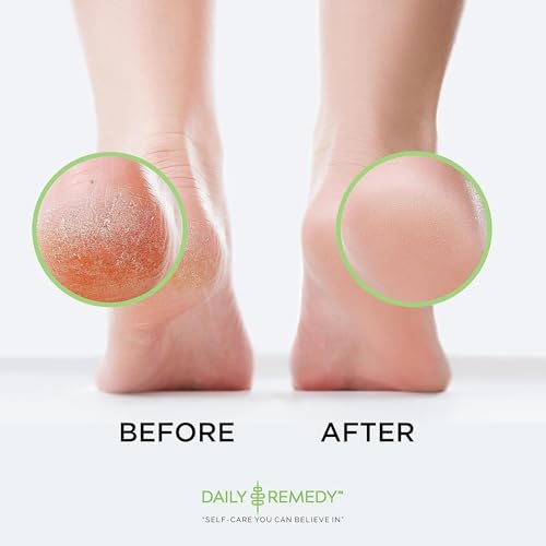 Callus Remover Gel ? Professional Foot Callus Removal for Smooth Feet & Cracked Heels ? Extra Strength Callus Gel with Pumice Stone ? 8oz, Made in USA