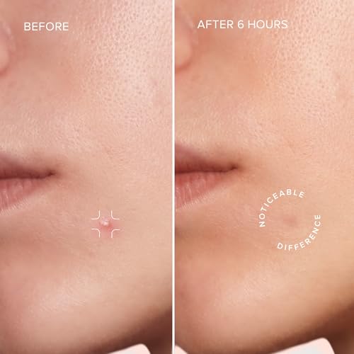 MAREE Star Pimple Patches for Face 2 PACK - Hydrocolloid Acne Patches w/Salicylic Acid, Tea Tree Oil & Centella - Cute Pimple Patches Stars - Teens Zit Patches Stickers - Parches Para Acne - 144 Dots