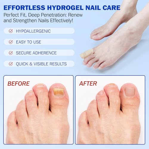 Nail Patches for 8-Hour Overnight Fast Hydrogel Nail Care, Keeps Feet Fresh & Dry All Day ? Men & Women (2)