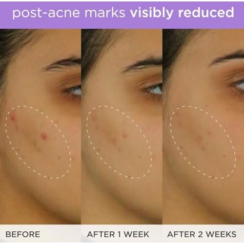 The Brightening Serum | Vitamin C Treatment for Brighter, Firmer Skin ? Targets Hyperpigmentation & Fades Post-Acne Marks, 30 ml / 1.0 fl. oz.