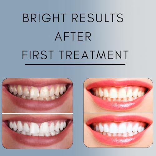 Teeth Whitening Gel for Trays - Pro Strength 44% Carbamide Peroxide, 5 Syringes (50 Treatments) + 2 Trays ? Enamel Safe, Removes Coffee & Other Stains