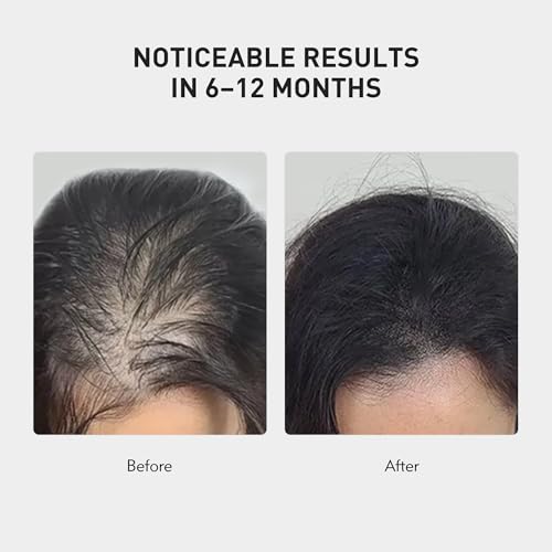 KINTOR 0.9% KX-826 Hair Regrowth Spray,Supporting Healthy Hair Growth,Oil Control, Hair Growth Products Group for Men&Women,Pro,60ml