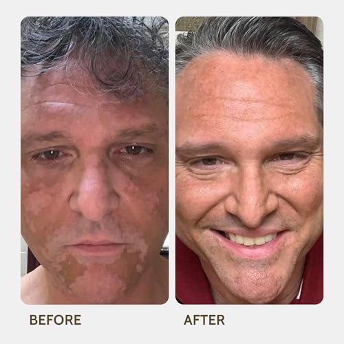 Vitiligo Vanquish Cosmetic Camouflage Kit by Fake Bake Liquid Concealer, Long Lasting Natural Color Customization Eliminates Appearance of Skin Depigmentation For Women & Men - Cover Lasts For Days