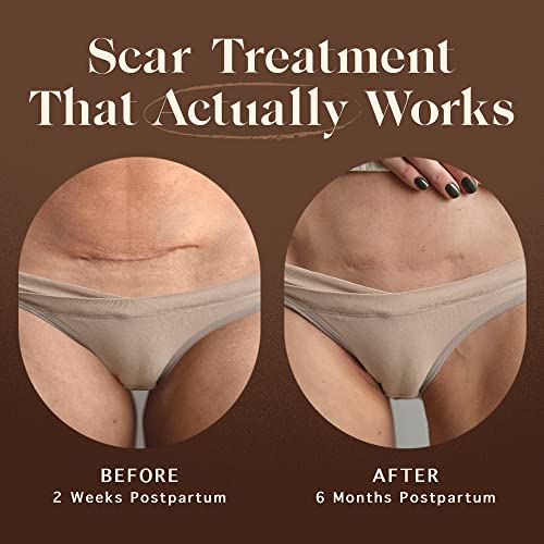 Nemah - Restorative Scar Treatment for C Section Recovery - C Section Scar Treatment for Postpartum - Reduces the Appearance of Scars from Acne - Vegan & Cruelty-Free - 1 oz.
