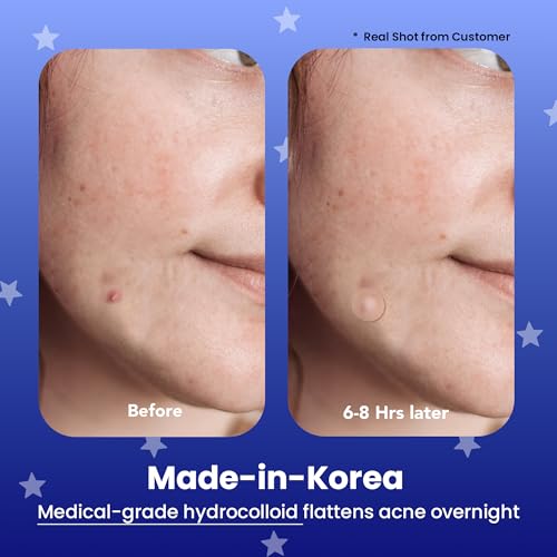 AVARELLE Spot Pimple Patches for Face | Good Night Acne Cover | Hydrocolloid with Tea Tree Oil | Acne Spot Treatment (12-14 mm, 96 ct)