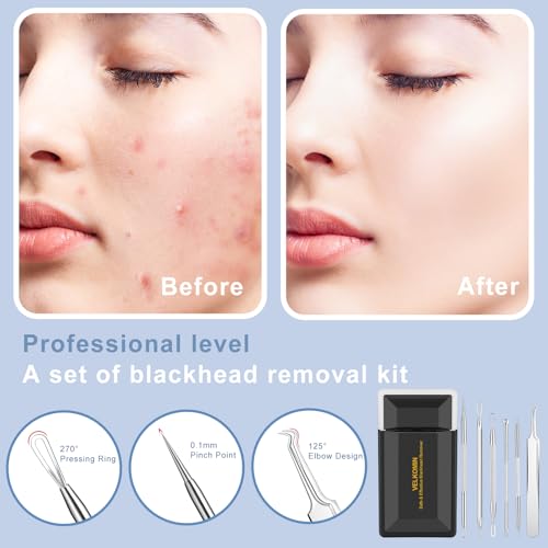 Pimple Extractor Tools, 6-PCS Professional Stainless Steel Blackheads, Whiteheads, Pimples, Boils, Stray Hairs Remover Tools Set with Mirror and Product User Manual, 18-Month Replacement Warranty£¡