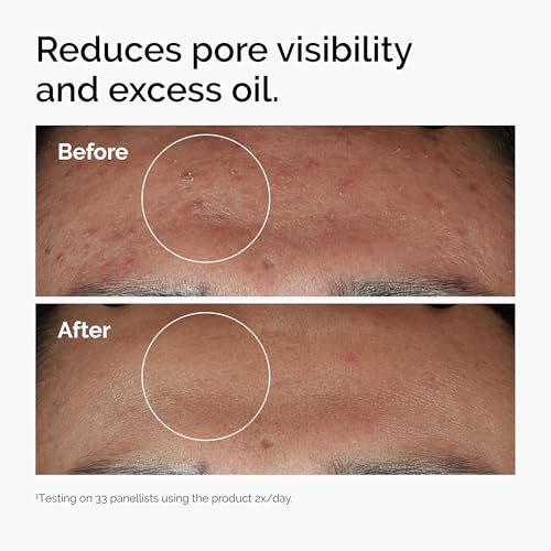 The Ordinary Niacinamide 10% + Zinc 1%, Smoothing Serum for Blemish-Prone Skin