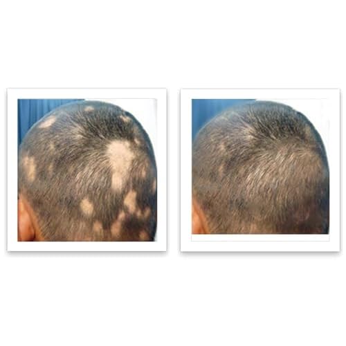 Caboki 10X Volumizing Hair Powder for Thinning Hair: Root Touch Up for Men and Women, Fill in Hairline & Edges, Cover Bald Spots. TALC-Free, Dark Gray