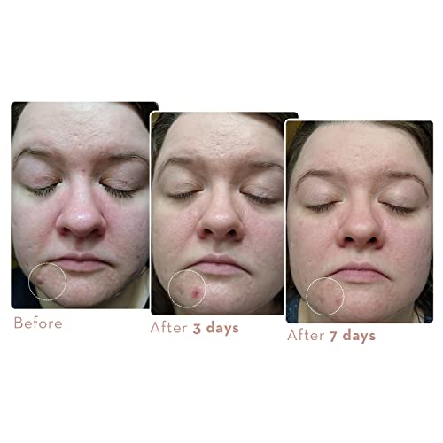 Sonage Zitlox Salicylic Acne Gel: Spot Treatment with Tea Tree Oil | Clears Acne Blemishes | Benzoyl Peroxide Alternative