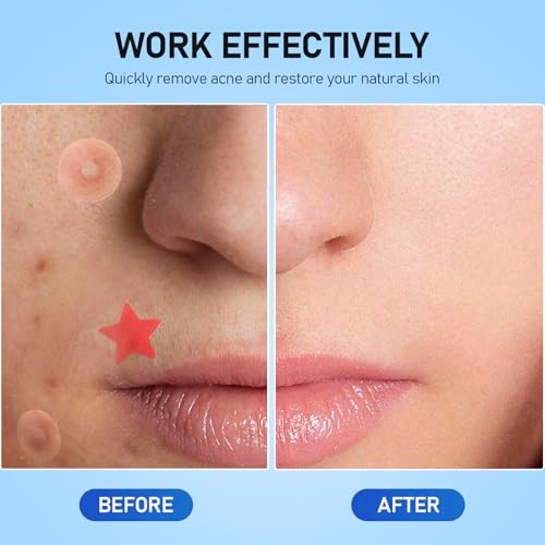 Pimple Patches for Face, 460 Counts Acne Patches, Hydrocolloid Zit Patches with Tea Tree Oil and Salicylic Acid, 4Sizes Cute Star Heart Shaped 11Colors£¨8/10/12/14mm£©