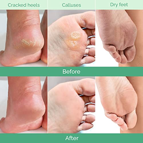 PLANTIFIQUE Foot Peeling Mask 2 Pack | Dermatologically Tested Repairs Heels & Removes Dry Dead Skin for Baby Soft Feet | Exfoliating Foot Peel Mask for Dry Cracked Feet | Peach
