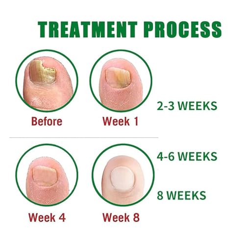 Nail Fungus Treatment Gel ? Multi-Purpose Nail Repair, Nail Growth Serum for Repair (2)