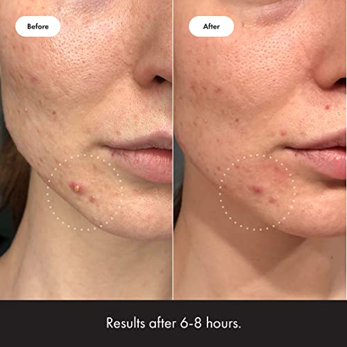 Mighty Patch¢â Invisible+ Patch - Daytime Hydrocolloid Acne Pimple Patches for Covering Zits and Blemishes, Ultra Thin Spot Stickers for Face and Skin (24 Medium and 15 Small Patches)