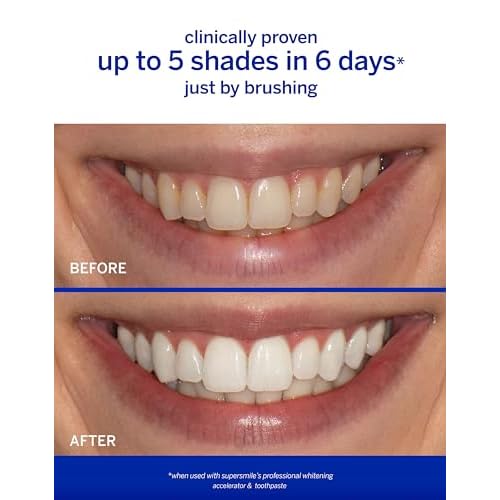 Supersmile Professional Whitening Accelerator - Powerful Whitening without Sensitivity - Safe and Effective on Dental Restorations (8 oz)