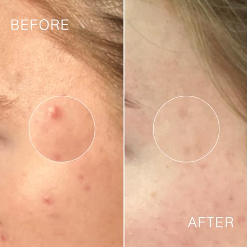 Dr Sebagh Complete Breakout Solution for Oily Skin - 1 x Balancing Cream (1.7 fl oz.) & 5 x Spot Treatment Powders (0.07 oz.) | Award-Winning | Rapid & Effective Results for Blemish-Prone or Oily Skin