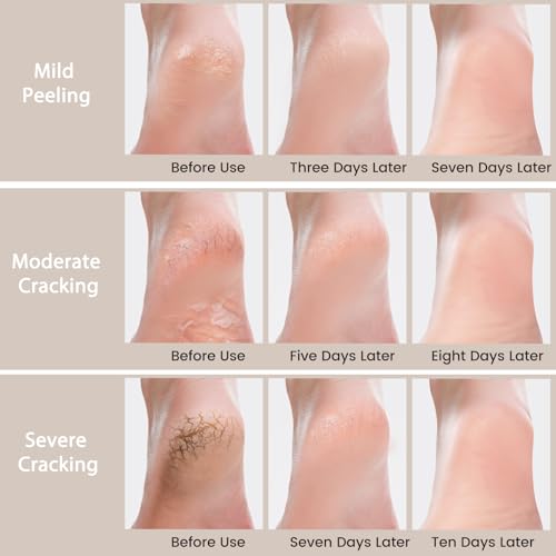 Urea Cream 40 Percent - Foot & Hand Cream for Dry, Cracked Heels, Feet, Knees, Elbows, and Hands - Maximum Strength Urea Lotion for Softening and Moisturizing