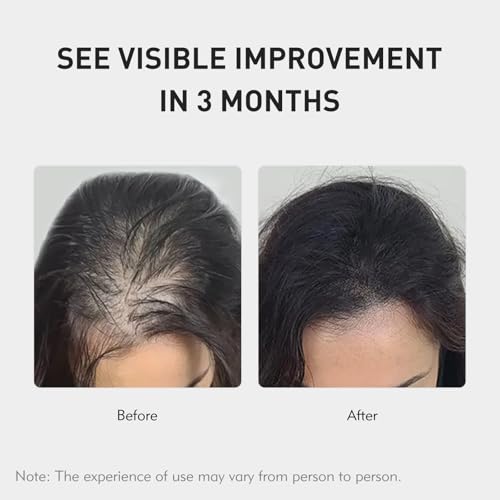 0.9% KX-826 KINTOR Hair Growth Spray,Strengthen Hair Nourish Hair follicles,Hair Care Products for Sparse Hair and Oily Hair Men&Women,60ml,Pro