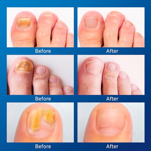Toenail Fungus Treatment Extra Strength - Nail Fungus Treatment For Toenail Extra Strength - Nighttime Nail Patches & Nail Treatment Liquid Set (32patches+15ml)