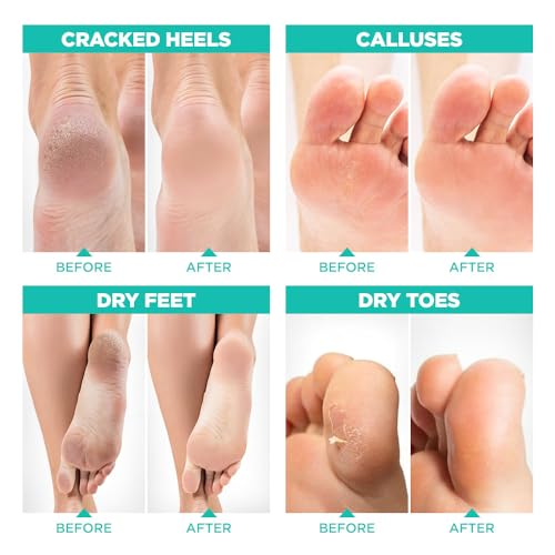 Lavinso Foot Peel Mask for Dry Cracked Feet ? 2 Pack Peeling Mask Removes Dead Skin and Calluses - Exfoliating for Soft Baby Feet, Original Scent
