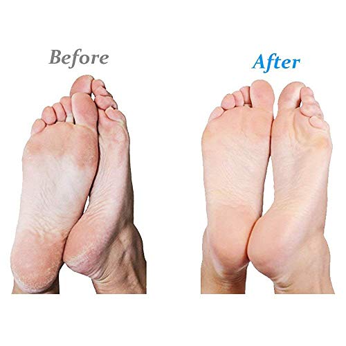 Emjoi Micro-Pedi Battery Operated Callus Remover