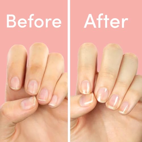 ella+mila "First Aid Kiss" Nail Strengthener and Growth treatment- Nail Repair Solution & Growth Treatment for Thin, Brittle & Damaged Nails - Nail Hardener with Vitamin E (0.45 fl oz)
