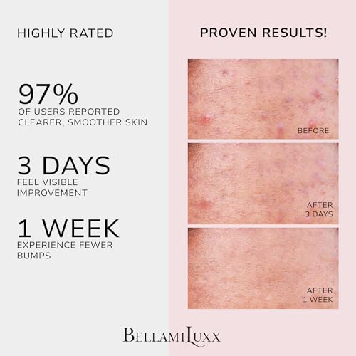 Butt Acne Clearing Treatment Cream: Body Acne Treatment for Folliculitis and Pimples on Buttocks, Thighs, and Body with 2% Salicylic Acid & Tea Tree Oil - Butt Cream for Smooth Skin