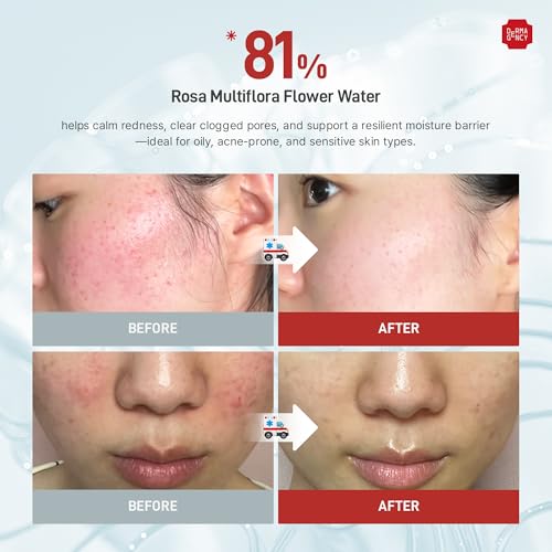 Zeroca 81 Korean Calming Serum for Acne-Prone & Oily Skin ? Balances Oil-Water, Soothes Redness, Fades Post-Blemish Marks, Firms & Hydrates (1.01 fl.oz. 30 ml)