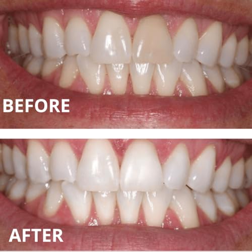 Teeth Whitening Gel Refills (6-gels). Made USA. 44 percent Carbamide Peroxide Tooth Bleaching Gel bleach For Invisalign style trays, Dental Grade Tooth Whitener. 6 syringes