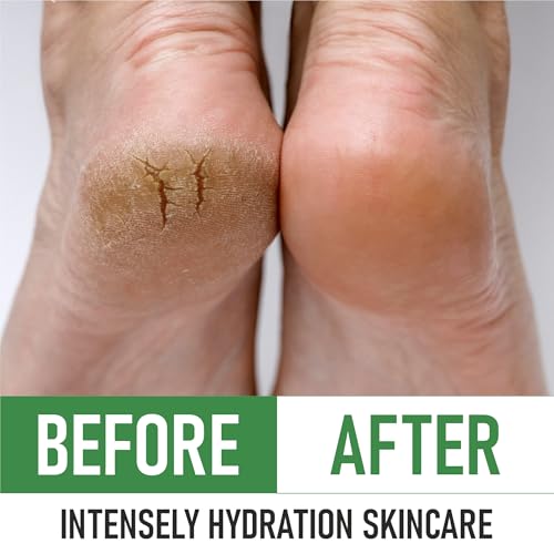 Urea 40% Foot Cream ? Made in USA, Dermatologist Tested, Intensive Repair for Dry, Cracked Heels, Corns, Calluses & Rough Feet, Professional Strength Exfoliating & Moisturizing Cream