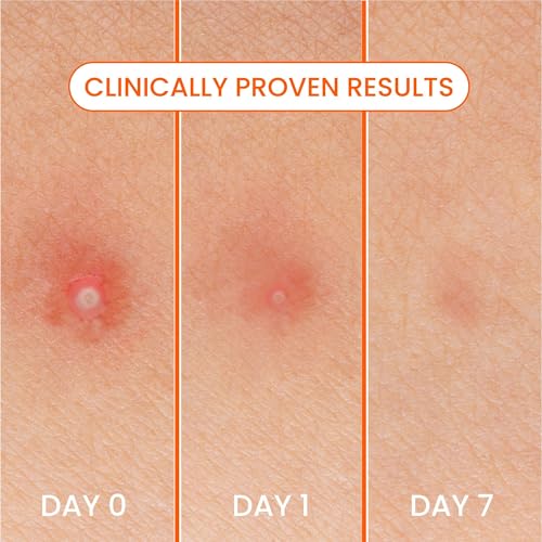 Biore Pimple Patches, Cover & Conquer Blemish Patch, Medical Grade Ultra-Thin Hydrocolloid for Covering Zits and Blemishes, HSA/FSA Approved, 30 Count