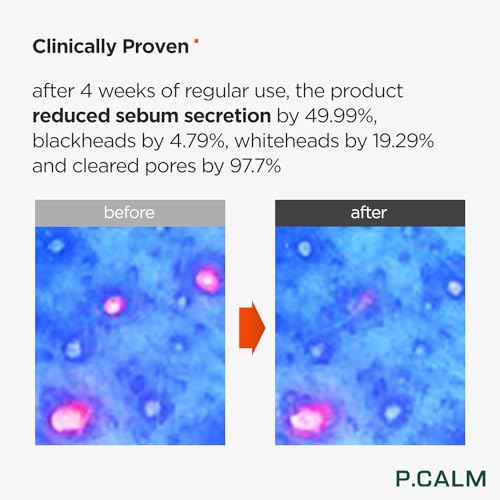 P.CALM Underpore Foam Cleanser ? Azulene for Deep Pore Cleansing, Blackhead & Whitehead Removal, Korean Vegan Facial Wash for Sensitive Skin (250ml / 8.45 fl.oz)