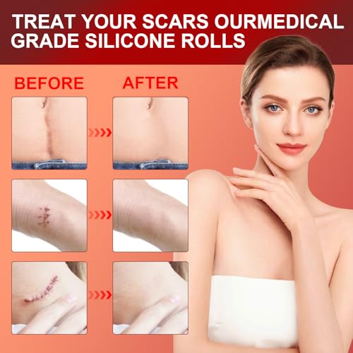 Silicone Scar Sheets (1.6¡±x 60¡± Roll-1.5M), Medical Grade Silicone Scar Tape Roll, Reusable Silicone Scar Strip, Professional Scar Removal Sheets for Surgery, C-Section, Burn, Keloid, Acne Etc