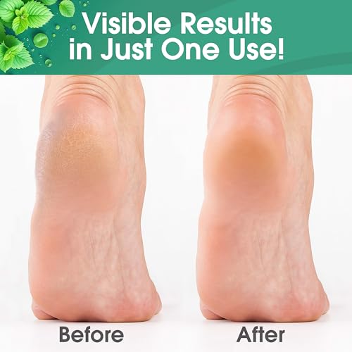 Callus Maintenance Pack, Bundle Includes Mint Scented Callus Remover, Metal Foot Rasp, Foot File, and 4 Pairs of Gloves, Salon Grade Foot Care, Home Manicure and Pedicure Kit