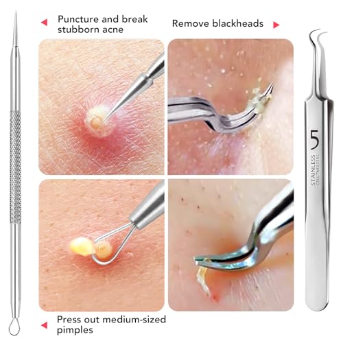 Litbear 6 Pcs Blackhead Remover Tools,Pimple Popper Tool Kit,Blackhead Pimple Comedones Extractor,Acne Tools Extractor kit, Scraper for Face Nose Deep Cleansing with Leather Case