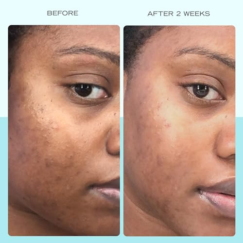 First Aid Beauty - Dark Spot Serum with Niacinamide, Helps Reduce Look of Dark Spots, Sun Spots, Hyperpigmentation, Discoloration & Post-acne marks, Non-Comedogenic, Safe for Sensitive Skin, 1 oz