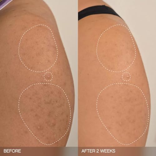 Slather Exfoliating & Smoothing Bar (2 Pack) ? Retinol Body Bar for KP, Dry & Textured Skin ? Hydrating, Smoothing, Gentle Exfoliation ? Safe for Sensitive Skin ? Light Lavender Scent