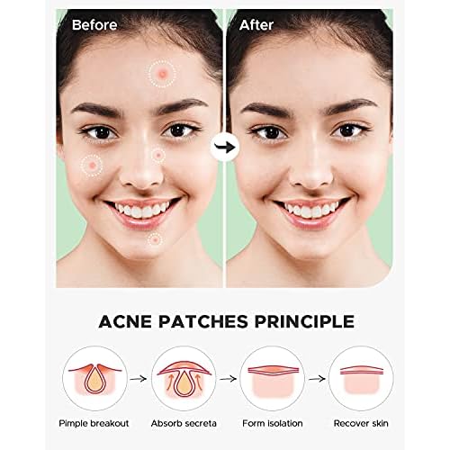 Pimple Patch (360 Counts 4 Sizes), Hydrocolliod Acne Patch for Face, Invisible Zit Patch with Tea Tree Oil & Calendula Oil, Blemish Patch
