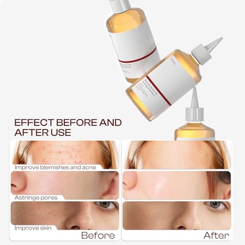Glycolic Acid 7% Exfoliating Toner: Glycolic Acid Toning Solution Which Soothes and Hydrates The Skin 100ml