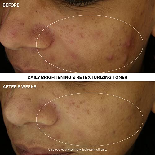StriVectin Multi Action Clear for Acne and Blemish Prone Skin for Clearer, Smooth and Brighter Skin, Less Breakouts and Pimples for Healthy Looking Skin