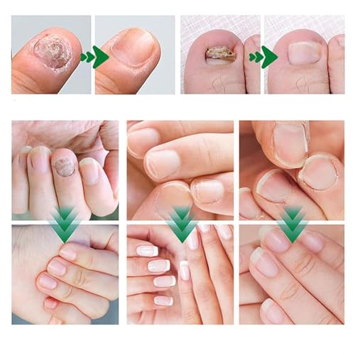 Nail Fungus Treatment Gel ? Multi-Purpose Nail Repair, Nail Growth Serum for Repair (2)