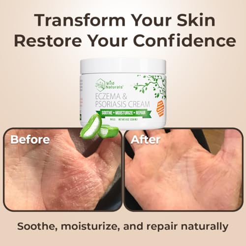 Wild Naturals Eczema & Psoriasis Cream for Dry, Itchy Skin ? Eczema Relief for Adults & Kids ? Moisturizing Psoriasis Cream with Manuka Honey
