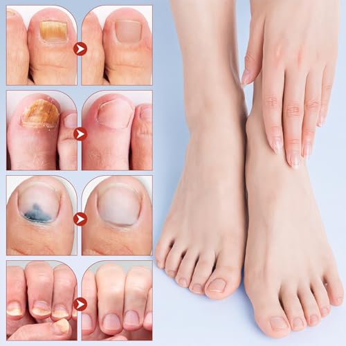Toenail Repair Extra Strength,Nail Patches 21 PCS, Overnight Nail Fast Acting Repair Effortless Hydrogel Nail Care for Men and Women