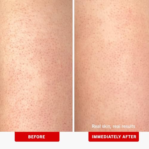 First Aid Beauty - KP Bump Eraser Body Scrub with 10% AHA, Keratosis Pilaris Exfoliator with Glycolic and Lactic acids, Helps Reduce Chicken Skin Bumps, Safe for Sensitive Skin, Strawberry Scent, 2 oz