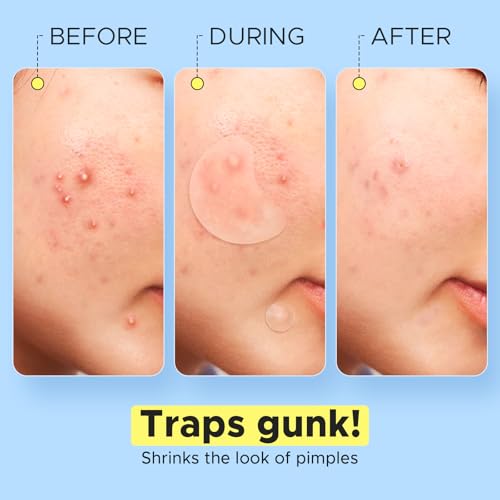 LitBear Pimple Patches for Face, Large Acne Patch, XL Hydrocolloid Bandages,Zit Stickers for Forehead, Chin, Nose, Body, Back, and Chest (5 Sizes, 228 Pimple Patches)