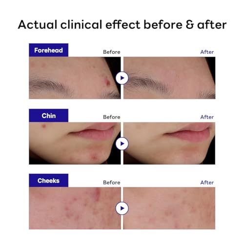 Mediheal Derma Clear Madecassoside Blemish Spot Patch (132 Counts) - Acne Spot Protection, Spot Fast Healing with Madecassoside & Niacinamide