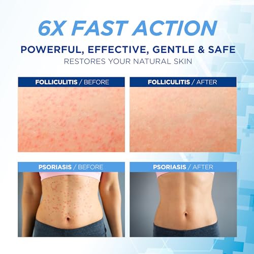 Folliculitis Treatment Cream: Effective Treatment for Folliculitis Scalp Face and Body 100g
