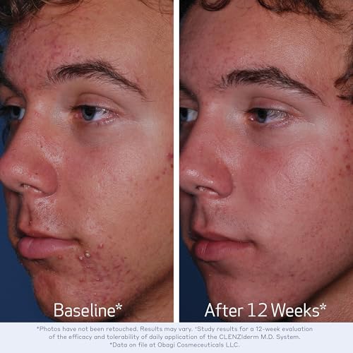 Obagi CLENZIderm M.D. Daily Care Foaming Acne Cleanser ? Acne Treatment with 2% Salicylic Acid (BHA)