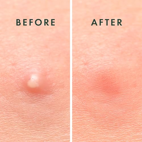 Rael Pimple Patches, Miracle Invisible Spot Cover - Hydrocolloid Acne Pimple Patch, Absorbs Zits & Blemish, Korean Skin Care, 2 Sizes (96 Count)