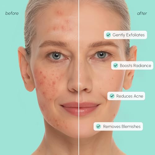 MAREE Azelaic Acid Toner Pads ? Exfoliating Pads with Glycolic & Hyaluronic Acid for Face ? 10% Azalecic Acid & Centella Redness Soothing Pad ? Zero Pore Facial Acne Care Toning Pad ? Acido Azelaico