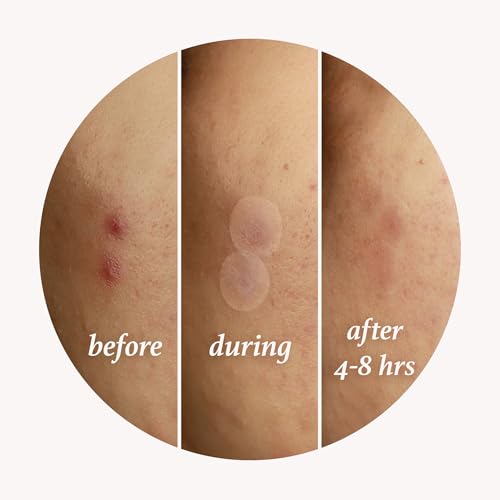 Julep Patch Me Up Waterproof Pimple Patches for Face ? 72 Hydrocolloid Clear Acne Patches with Tea Tree Oil, Ultra-Thin Acne Stickers, Reduces Blemishes & Scarring ? 48 8mm & 24 12mm Patches